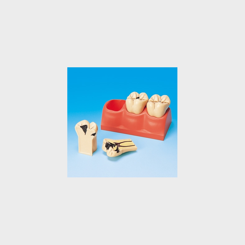 Stor Caries Studiemodel 